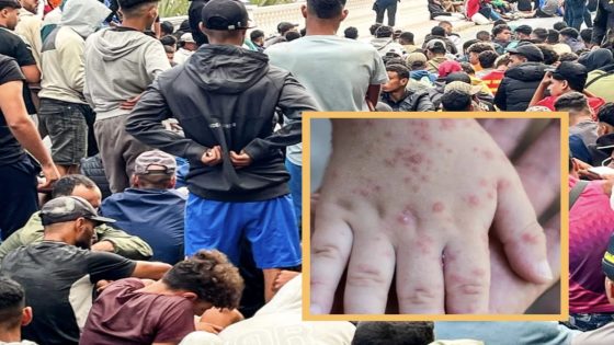 سبتة: تسجيل أول إصابة بـ«مبوكس» لدى قاصر مغربي يبلغ 13 سنة